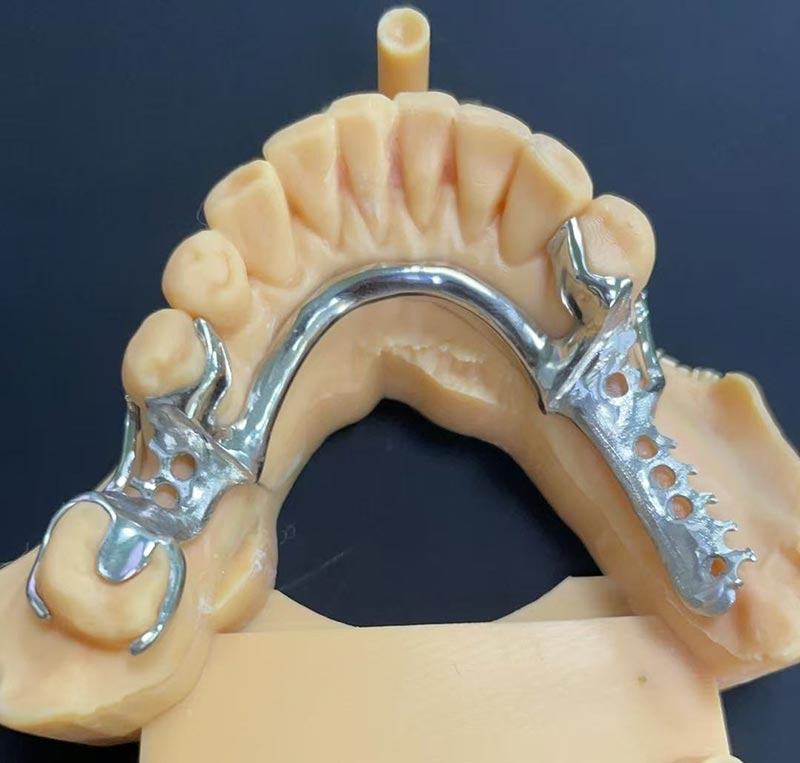 కోబాల్ట్-క్రోమియం ఫ్రేమ్‌వర్క్ (Co Cr ఫ్రేమ్‌వర్క్) యొక్క ప్రయోజనాలు