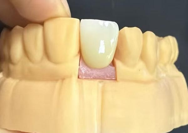 దంతాల మధ్య ఖాళీలను పరిష్కరించవచ్చు-నిటారుగా ఉండే దంతాలు అత్యంత ఆకర్షణీయమైనవి!