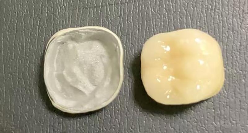 మీ పింగాణీ క్రౌన్ చిప్స్ ఉన్నప్పుడు ఏమి చేయాలి? ఇది ఎందుకు జరుగుతుంది & దాన్ని ఎలా పరిష్కరించాలో ఇక్కడ ఉంది