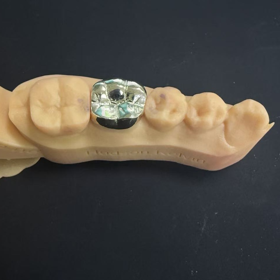 బంగారు కిరీటాలు: జీవితకాల దంత పునరుద్ధరణ కోసం విలువైన మెటల్ ఎంపిక