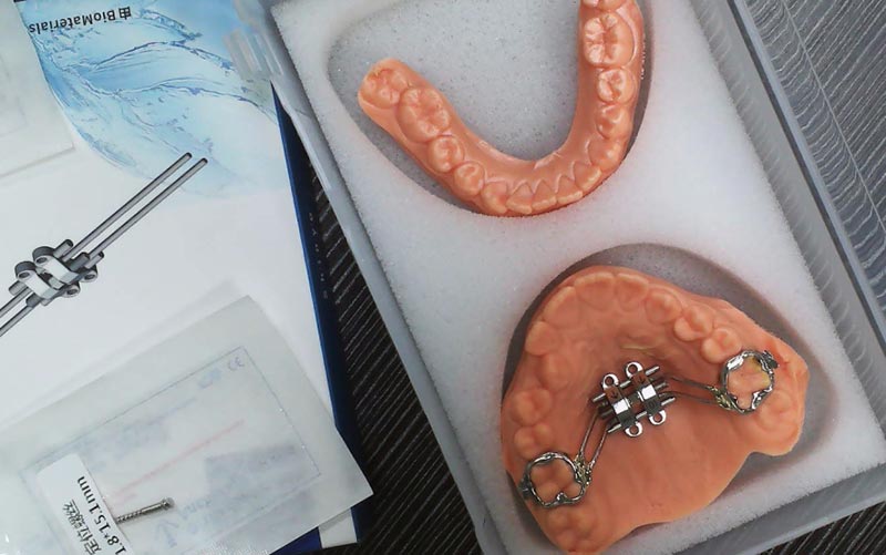 WM డెంటల్ ల్యాబ్‌తో MSE అస్థిపంజర విస్తరణను అర్థం చేసుకోండి