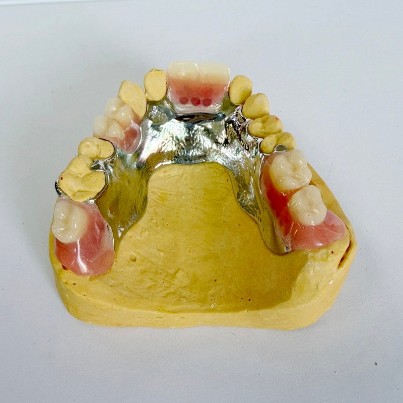 తొలగించగల పునరుద్ధరణ పాక్షిక ఫ్రేమ్‌వర్క్